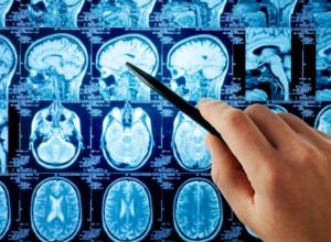 Neurology